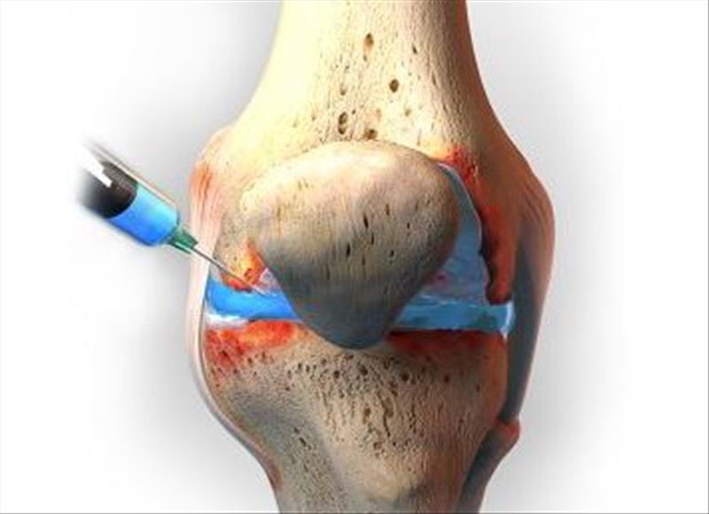 چرا پی ­آرپی باید اولین انتخاب تزریقی در درمان آرتروز زانو باشد؟