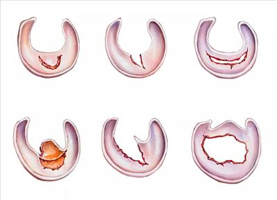 انواع پارگی های مینیسک زانو و درمان آنها